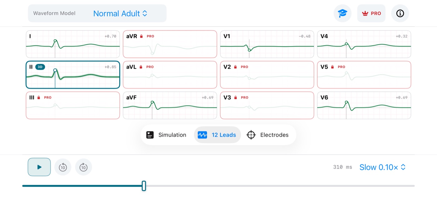 The synchronized 12-lead overview in ECG Vector for iPhone
